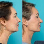 12mths Post-op Face and Neck Lift