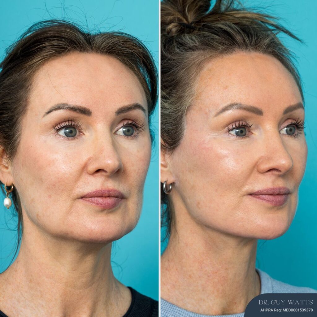 12mths Post-op Face and Neck Lift