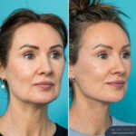 12mths Post-op Face and Neck Lift