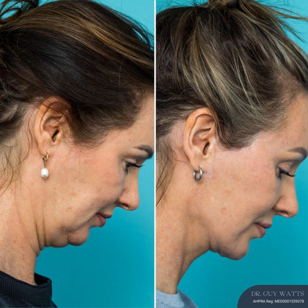 12mths Post-op Face and Neck Lift