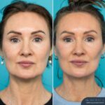 12mths Post-op Face and Neck Lift