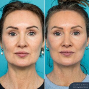 12mths Post-op Face and Neck Lift