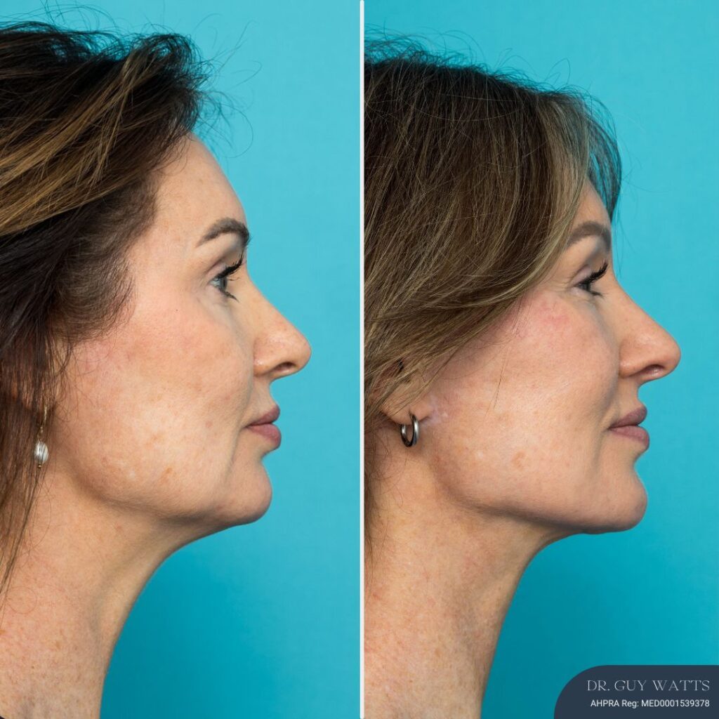 12mths Post-op Face and Neck Lift