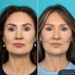 12mths Post-op Face and Neck Lift