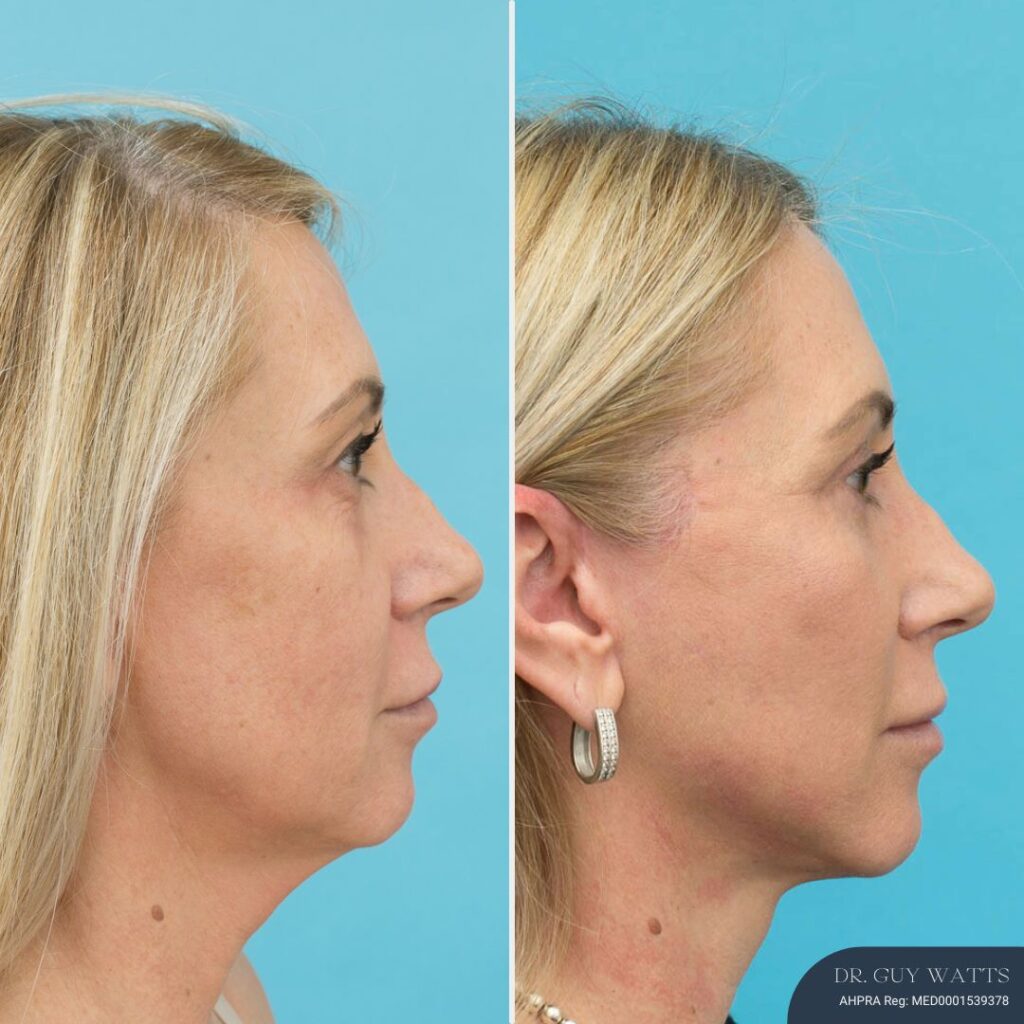 5 Months Post Face and Neck Lift + Upper and Lower Blepharoplasty