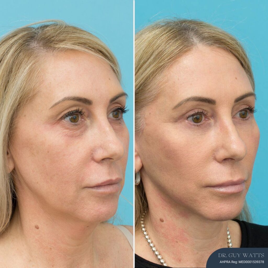 5 Months Post Face and Neck Lift + Upper and Lower Blepharoplasty