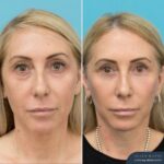5 Months Post Face and Neck Lift + Upper and Lower Blepharoplasty
