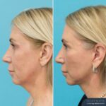 5 Months Post Face and Neck Lift + Upper and Lower Blepharoplasty