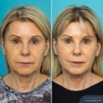 3 Months Post-op Face & Neck Lift - F