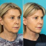 3 Months Post-op Face & Neck Lift - R45