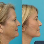 3 Months Post-op Temporal Brow Lift + Upper Blepharoplasty + Face and Neck Lift + TCA Peel