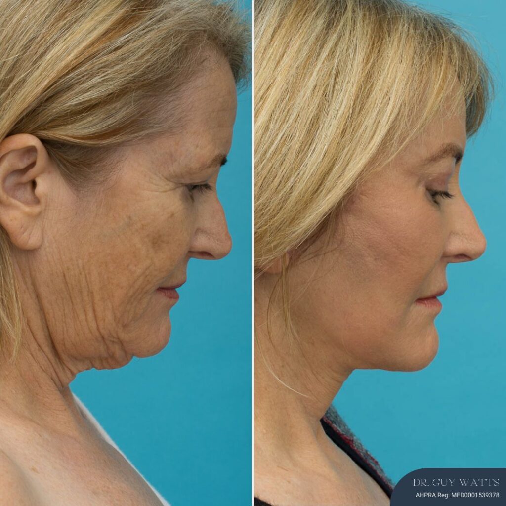 3 Months Post-op Temporal Brow Lift + Upper Blepharoplasty + Face and Neck Lift + TCA Peel