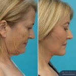 3 Months Post-op Temporal Brow Lift + Upper Blepharoplasty + Face and Neck Lift + TCA Peel