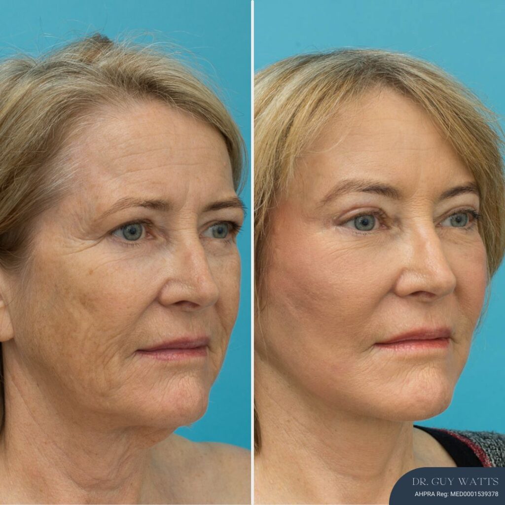 3 Months Post-op Temporal Brow Lift + Upper Blepharoplasty + Face and Neck Lift + TCA Peel