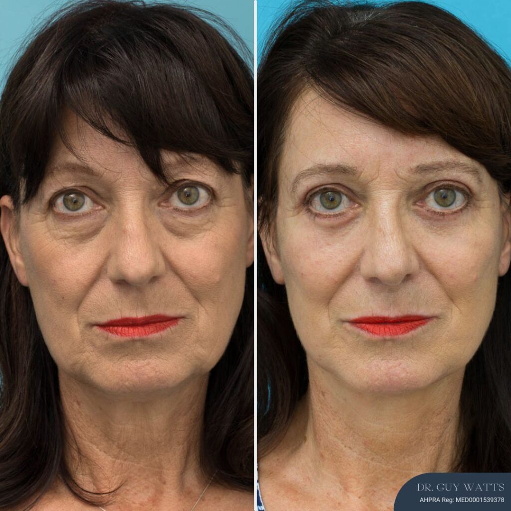 3 Months Post-op Rhinoplasty + Face and Neck Lift + Upper and Lower Blepharoplasty