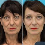 3 Months Post-op Rhinoplasty + Face and Neck Lift + Upper and Lower Blepharoplasty