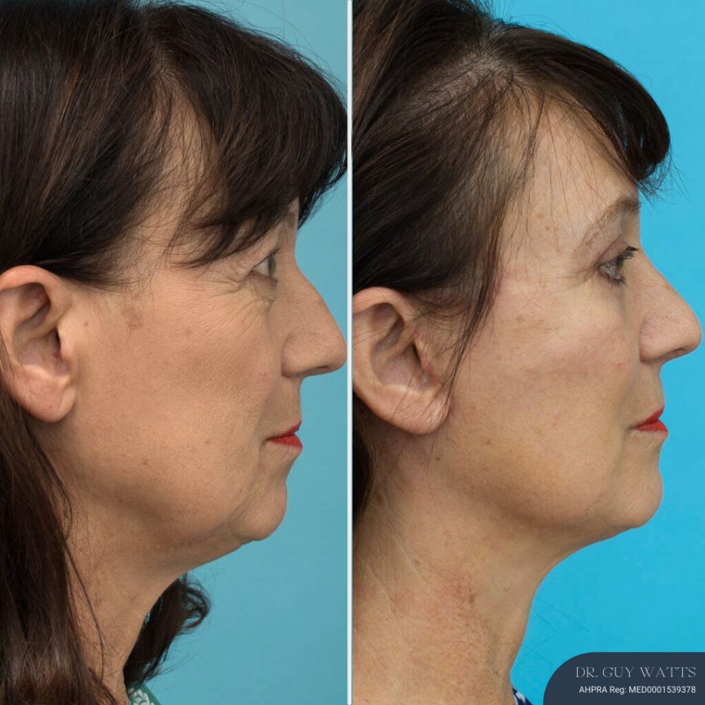 3 Months Post-op Rhinoplasty + Face and Neck Lift + Upper and Lower Blepharoplasty