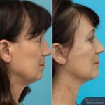 3 Months Post-op Rhinoplasty + Face and Neck Lift + Upper and Lower Blepharoplasty