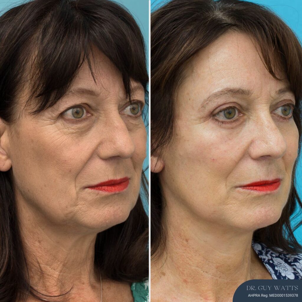3 Months Post-op Rhinoplasty + Face and Neck Lift + Upper and Lower Blepharoplasty