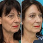 3 Months Post-op Rhinoplasty + Face and Neck Lift + Upper and Lower Blepharoplasty