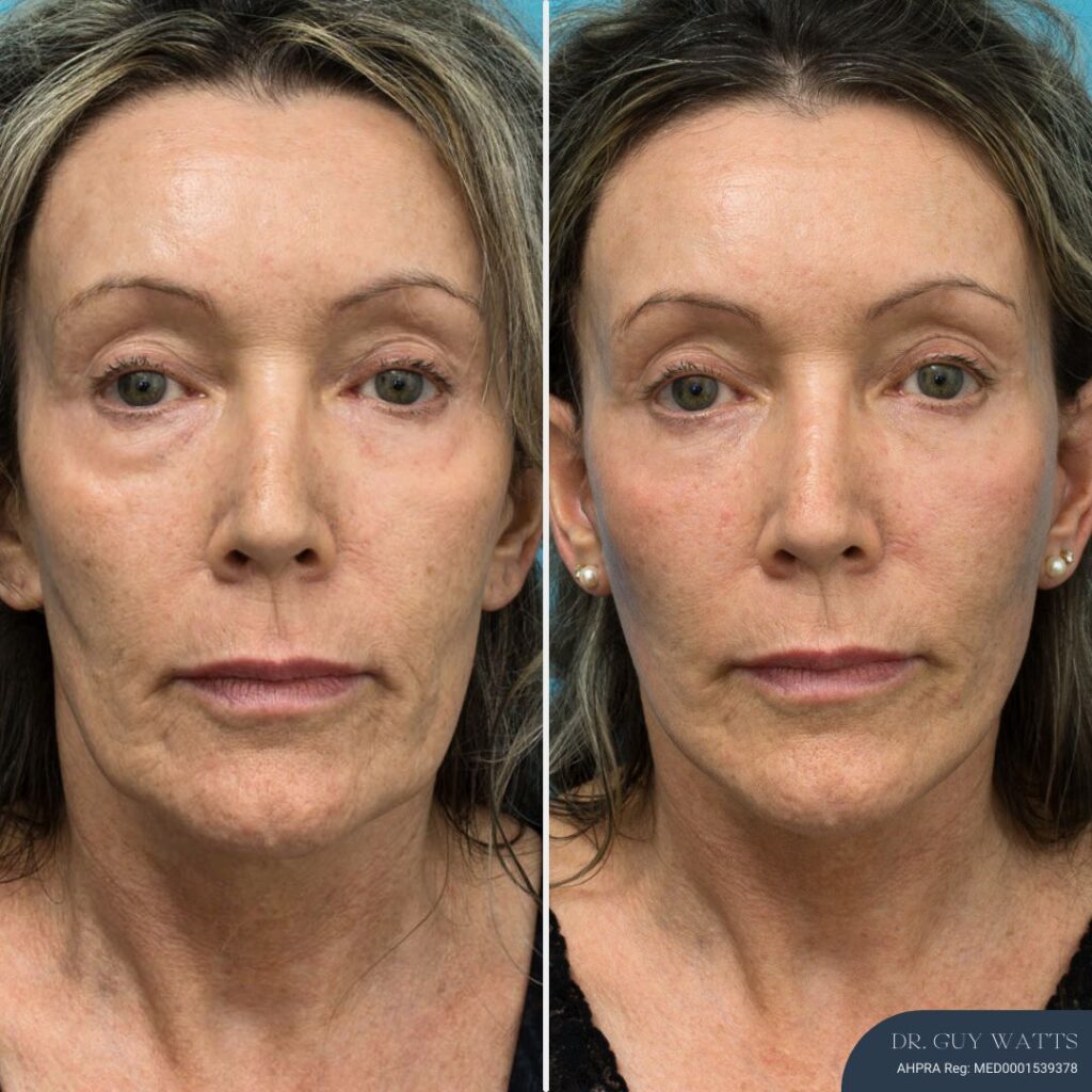 3 Months Post-op Face and Neck Lift + Lower Blepharoplasty