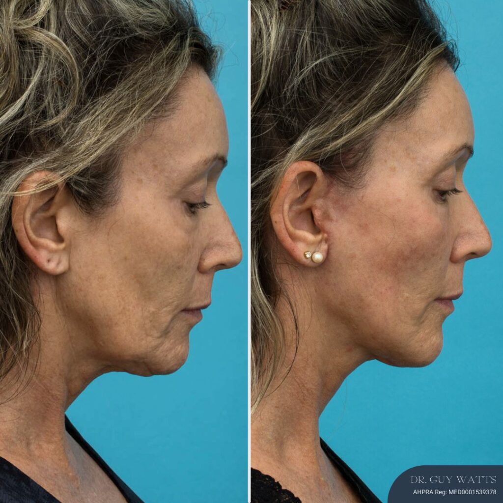 3 Months Post-op Face and Neck Lift + Lower Blepharoplasty