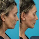 3 Months Post-op Face and Neck Lift + Lower Blepharoplasty