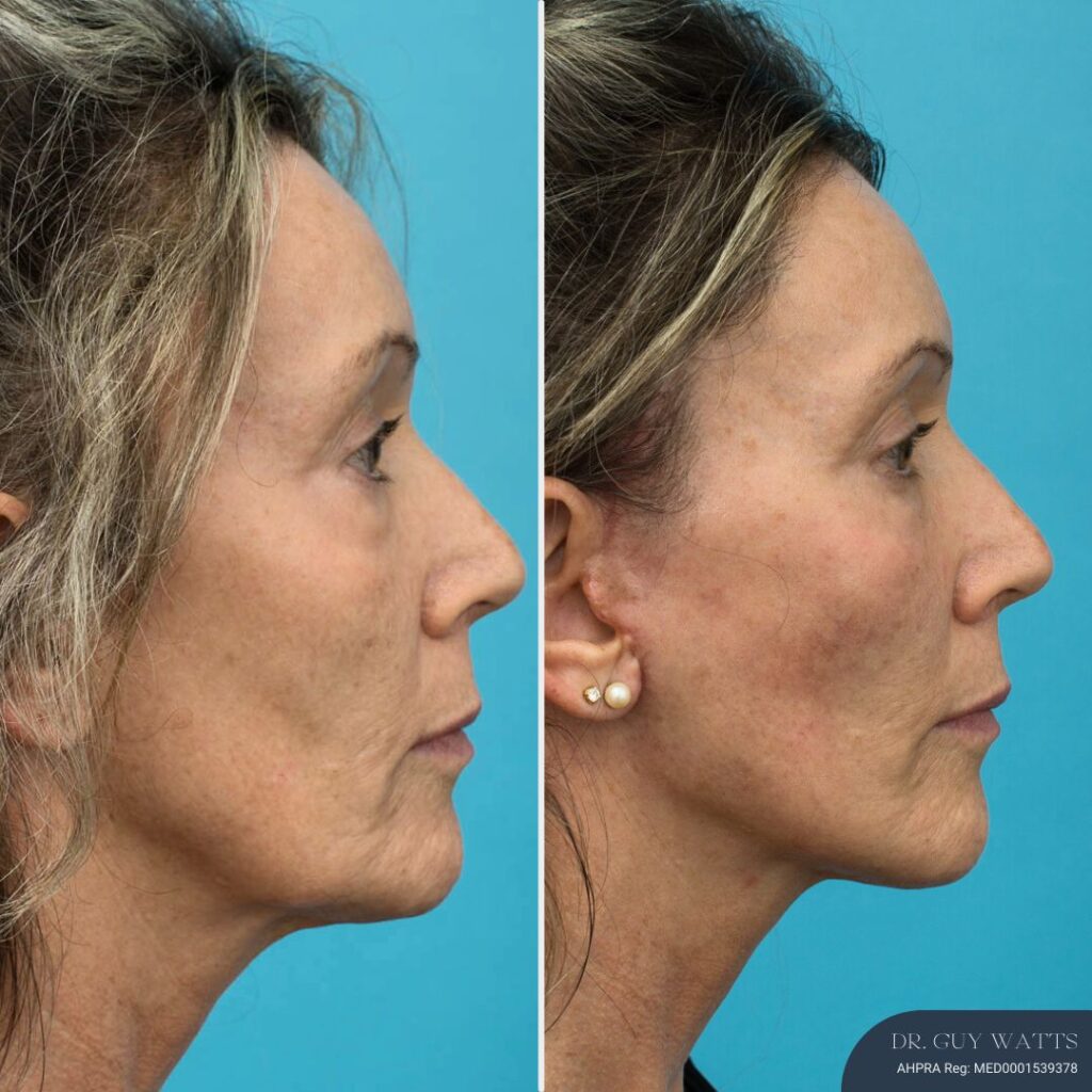 3 Months Post-op Face and Neck Lift + Lower Blepharoplasty