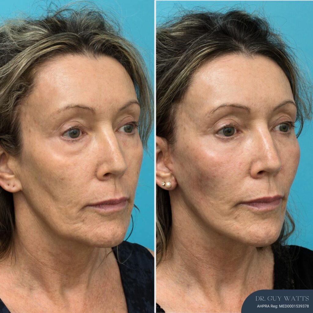 3 Months Post-op Face and Neck Lift + Lower Blepharoplasty