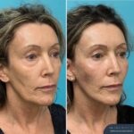 3 Months Post-op Face and Neck Lift + Lower Blepharoplasty