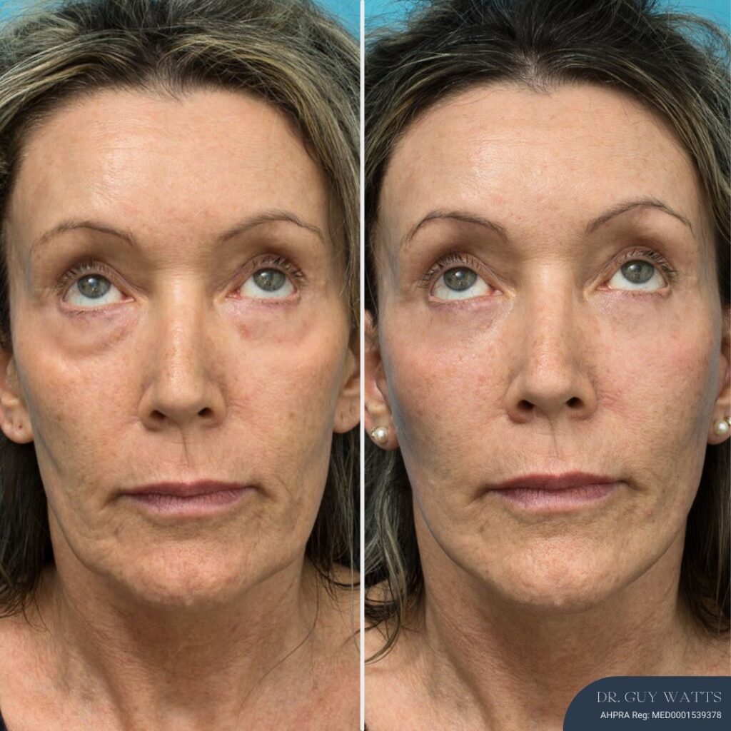 3 Months Post-op Face and Neck Lift + Lower Blepharoplasty