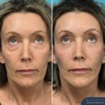 3 Months Post-op Face and Neck Lift + Lower Blepharoplasty