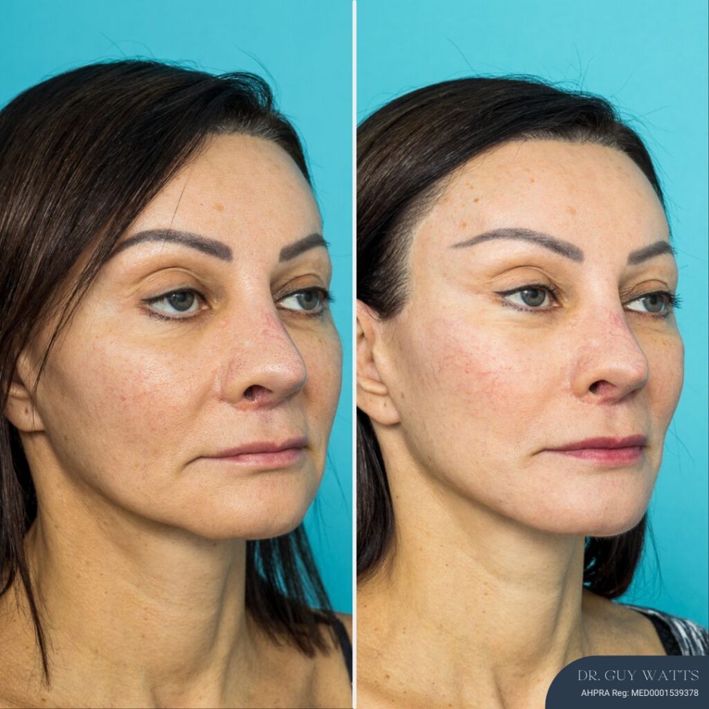 12mths Post Face Lift and Posterior Neck Lift