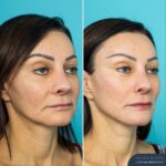 12mths Post Face Lift and Posterior Neck Lift