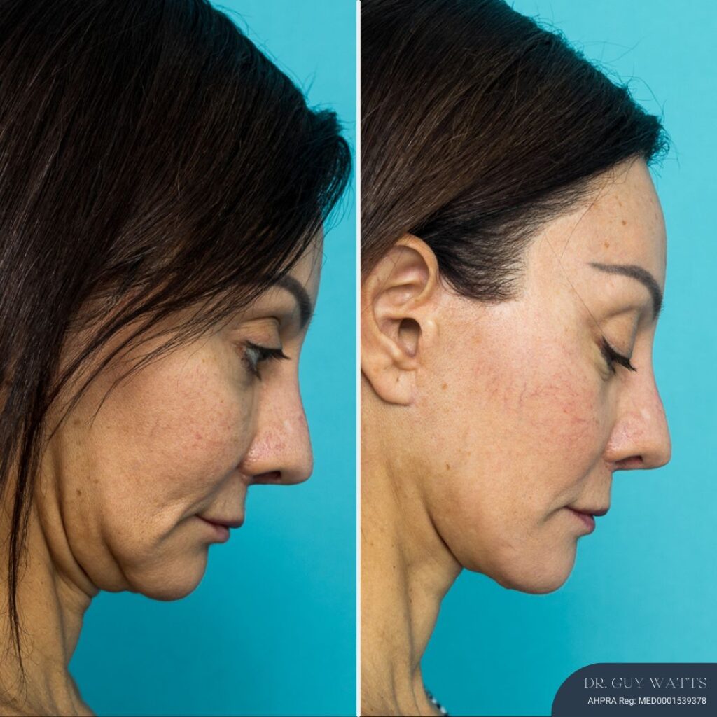 12mths Post Face Lift and Posterior Neck Lift