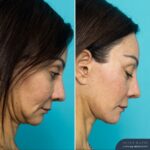 12mths Post Face Lift and Posterior Neck Lift