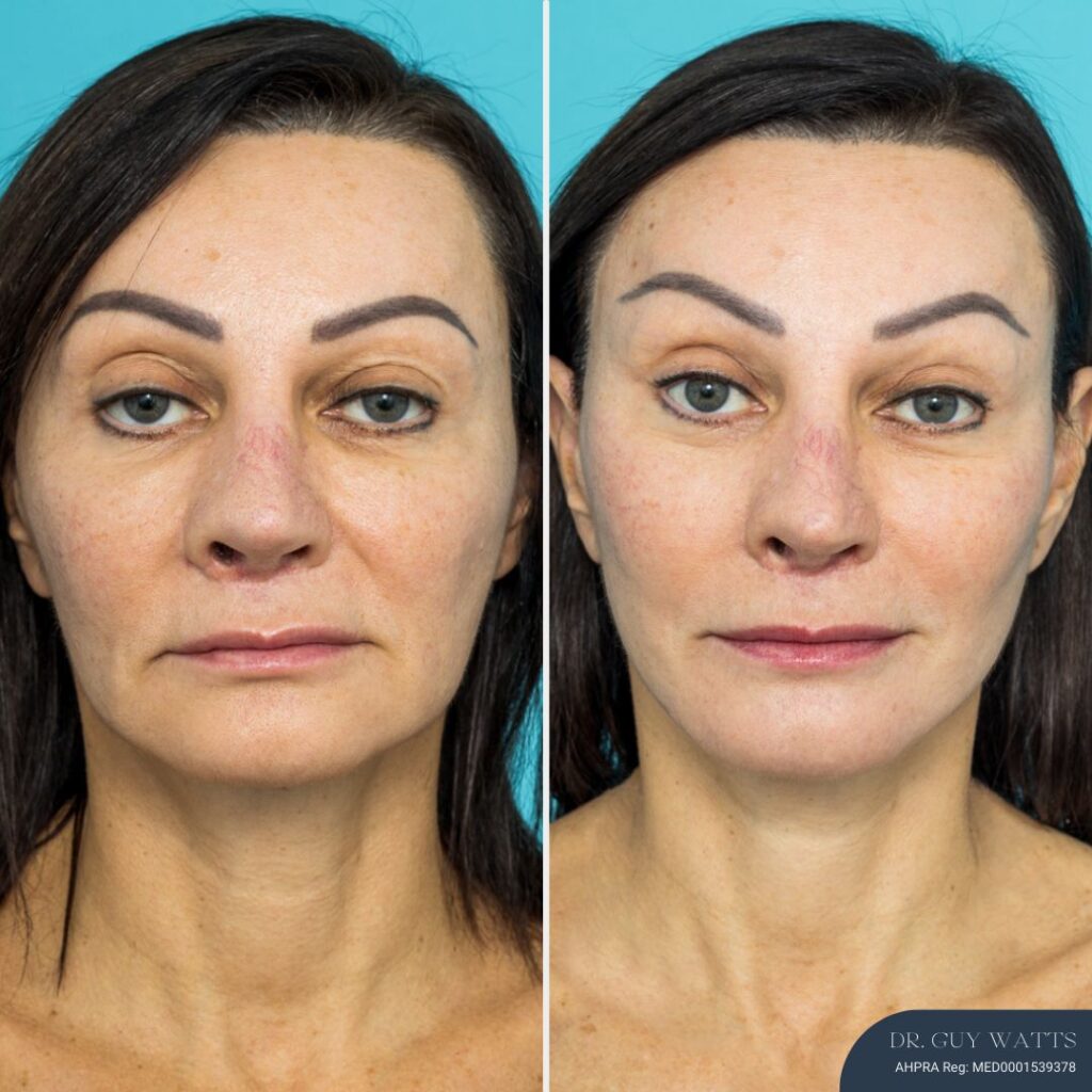 12mths Post Face Lift and Posterior Neck Lift