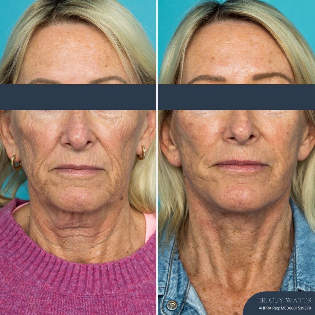 12 Months Post-op Deep Plane Face Lift, Neck Lift and Gliding Brow Lift + TCA Peel