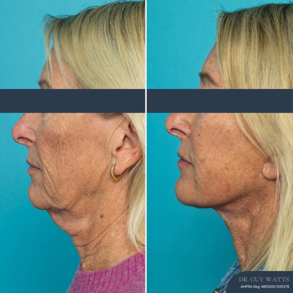 12 Months Post-op Deep Plane Face Lift, Neck Lift and Gliding Brow Lift + TCA Peel