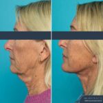 12 Months Post-op Deep Plane Face Lift, Neck Lift and Gliding Brow Lift + TCA Peel