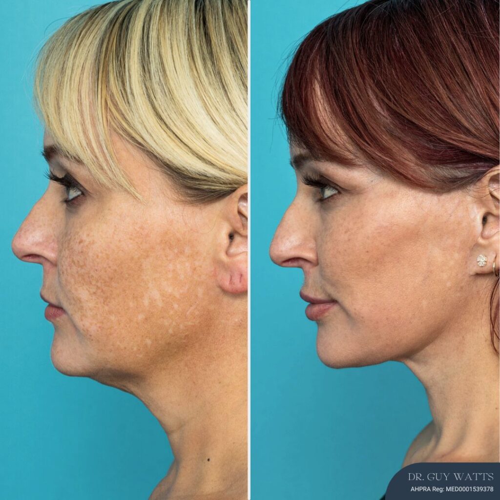 12 Months Post-op Deep Plane Face Lift, Neck Lift and Gliding Brow Lift