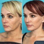 12 Months Post-op Deep Plane Face Lift, Neck Lift and Gliding Brow Lift