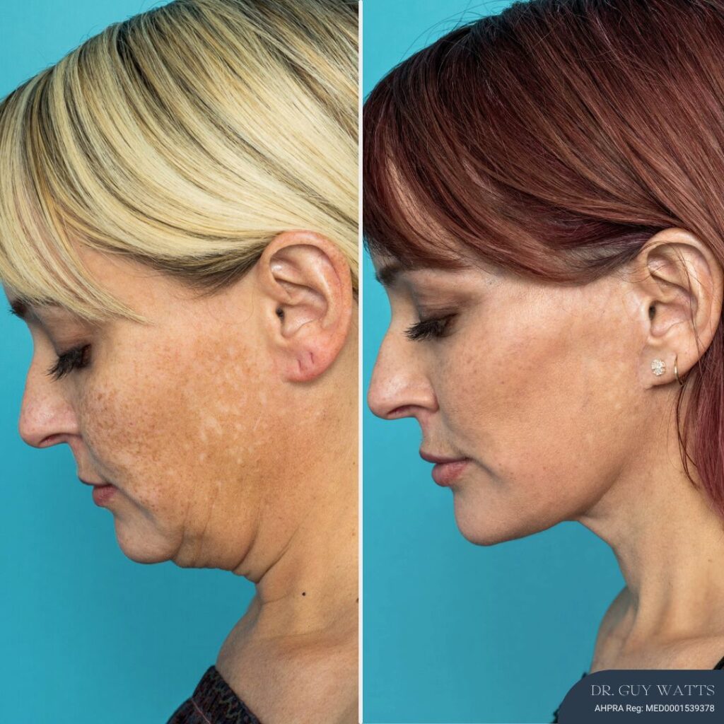 12 Months Post-op Deep Plane Face Lift, Neck Lift and Gliding Brow Lift