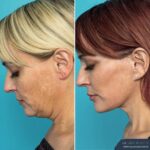 12 Months Post-op Deep Plane Face Lift, Neck Lift and Gliding Brow Lift