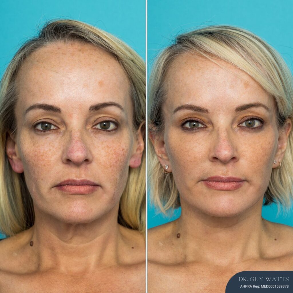Post-op Face Lift