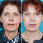 12 Months Post-op Face and Neck Lift + Brow Lift