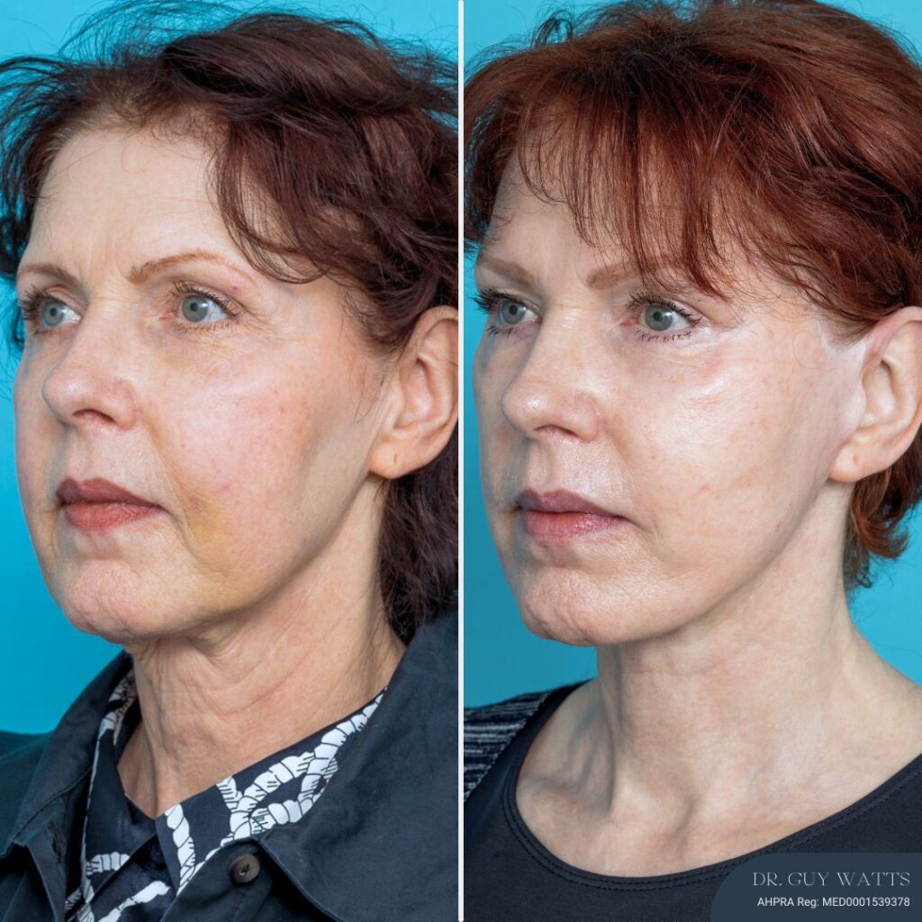 12 Months Post-op Face and Neck Lift + Brow Lift