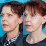 12 Months Post-op Face and Neck Lift + Brow Lift