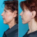 12 Months Post-op Face and Neck Lift + Brow Lift