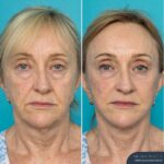 12 Months Post-op Face Lift and Posterior Neck Lift